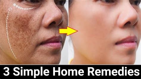 Remove Face Pigmentation Naturally Youtube
