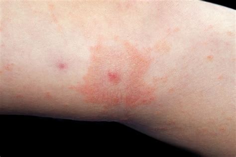 Viral Urticaria Photograph By Dr P Marazziscience Photo Library