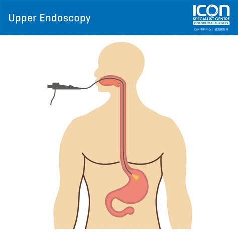Upper Endoscopy Pictures
