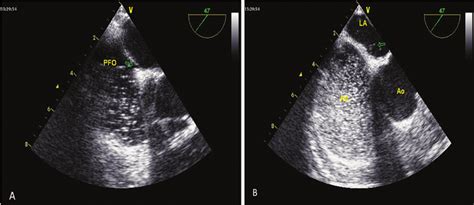 Echocardiography Of The Patient Shows A Small Patent Foramen Ovale