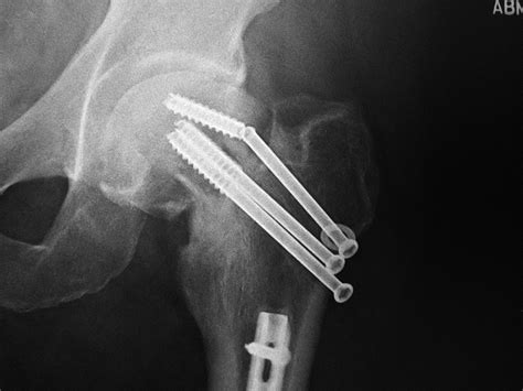 Complications Of Fracture Fixation A Gallery