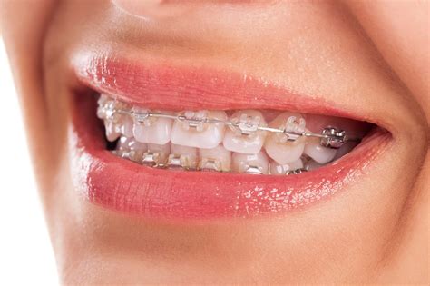 Braces Or Invisalign How To Know Which Is Right For You