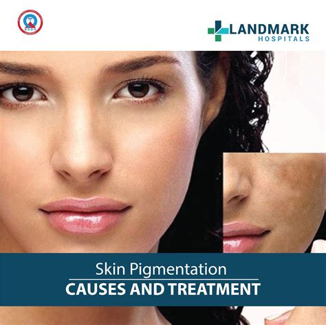 Skin Pigmentation Causes And Treatment Landmark Hospitals