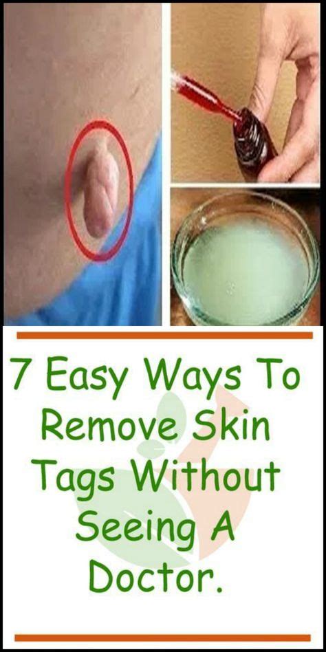 7 easy ways to remove skin tags without seeing a doctor skin tag removal natural remedies for