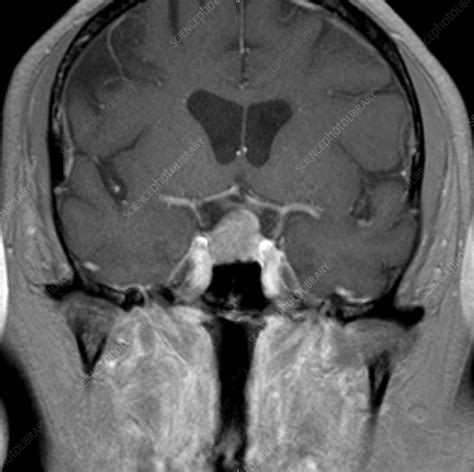 Pituitary Macroadenoma Mri Stock Image C0393567 Science Photo