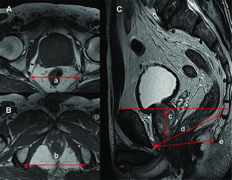 A B The Cross Section And C Sagittal Section Of Prostate On An Mri Download Scientific