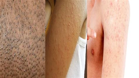 How To Get Rid Of Tiny Bumps On Skin Chicken Skin Keratosis Pilaris