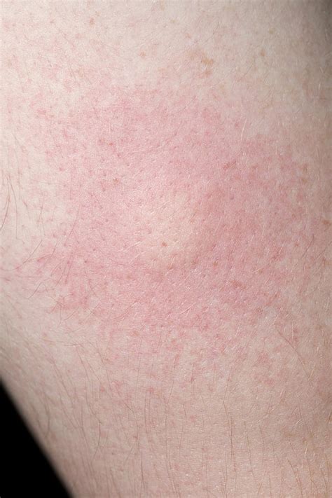 Insect Bite Allergic Reaction Rash