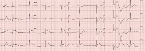 Stemi Case Study How Rtvs Helps Bc Emergency Medicine Network