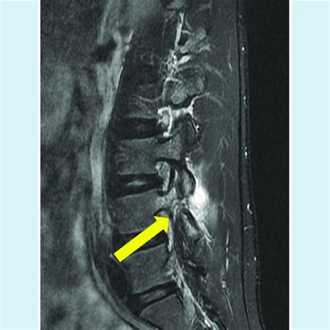 Sagittal Fat Saturated T2 Weighted Image Showing A Defect Of The Right