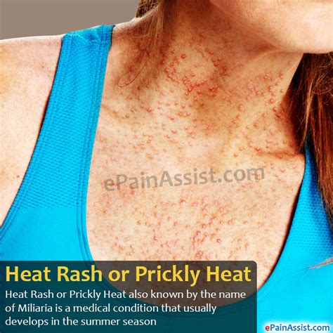 Heat Rash Symptoms In Adults Prickly Heat Causes Symptoms Diagnosis And Treatment Natural