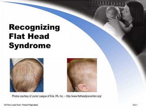 The Connection Between Flat Head Syndrome And Autism Put Children First