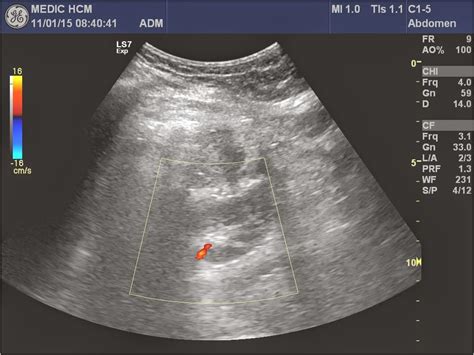 Vietnamese Medic Ultrasound Case 293 Kidney Abscess Dr Phan Thanh