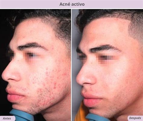 Clínica Láser De Piel Acne Activo Con Láser Clínica Láser De Piel