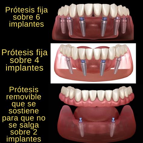 Prótesis Fija Sobre Implantes Protesis Dental Fija Protesis Fija Protesis Dentales