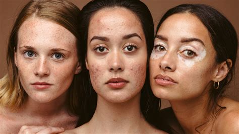 How To Treat Hormonal Acne In 2023 According To Dermatologists Lupon