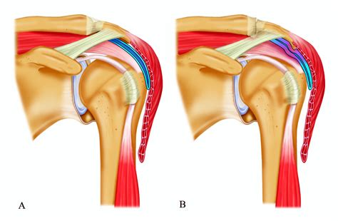 Study Protocol Subacromial Impingement Syndrome The Identification Of