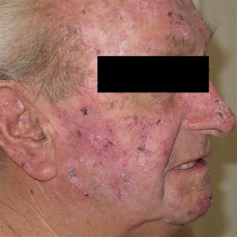 Man With Multiple Actinic Keratoses And Field Cancerization On The