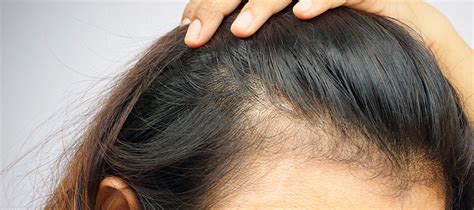 Alopecia En Mujeres Itc Medical