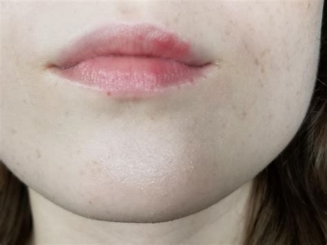 Help Bumpy Textured Red Patches On Upper Lip Skin Concerns Rskincareaddiction
