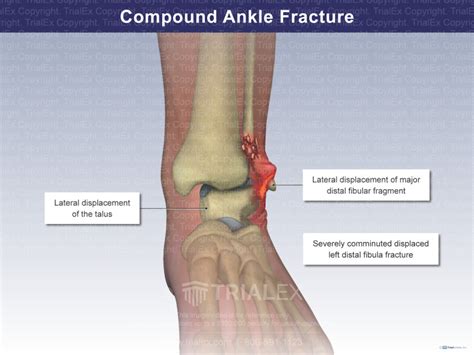 Compound Ankle Fracture Trial Exhibits Inc