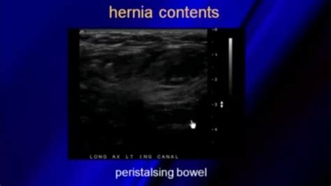 Ultrasound Of Hernias Ultrasound Lockscreen Screenshot Lockscreen