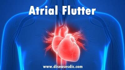 Atrial Flutter Causes Types Treatment And Prevention
