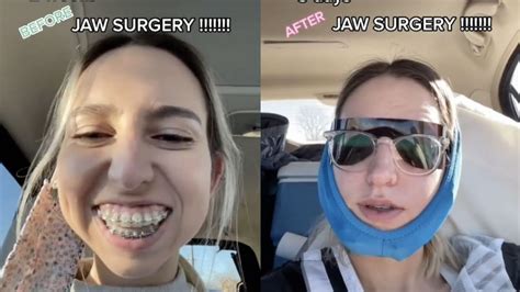23 Year Olds Jaw Surgery Transformation Stuns TikTok