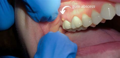 Why Is There A Bump In My Gums Shenton Dental Surgery 84144023
