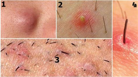 How To Get Rid Of Ingrown Hair Cyst On Inner Thigh Howotremvo
