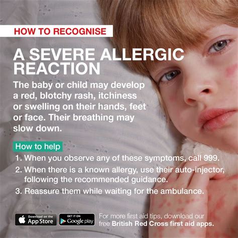 Learn How To Help A Baby Or Child Having A Severe Allergic Reaction