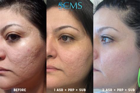 Acne Scar Removal Before And After With Prp And Subcision Laser Skin Rejuvenation Laser
