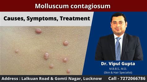 Molluscum Contagiosum Causes Symptoms Treatment Youtube