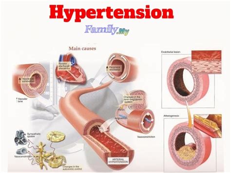 Hypertension Healthcare Malaysia
