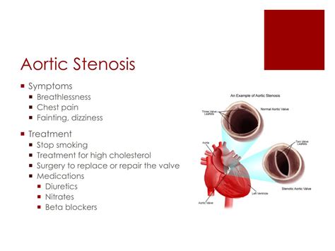 Ppt Aortic Stenosis Powerpoint Presentation Free Download Id4055207