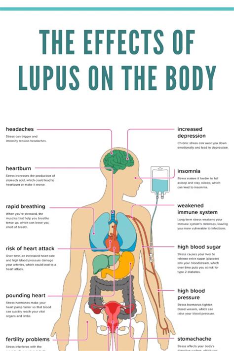 Pin On Lupus Symptoms And Treatments