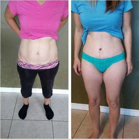 Tummy Tuck Before And After Pics And Picture Tummy Tuck Prices Photos Reviews Info Qanda