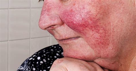 Hautkrankheit Rosacea früh erkennen und wirksam behandeln