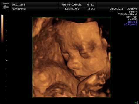 Unser baby, 3d ultraschall 22.ssw. 3D/4D Ultraschall | Dr. med. Leoni Häfner