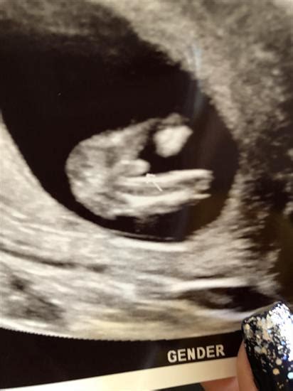 Can Ultrasound Be Wrong About Gender Lenaeveryday