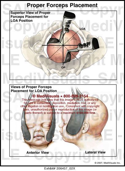 Medivisuals Proper Forceps Placement Medical Illustration