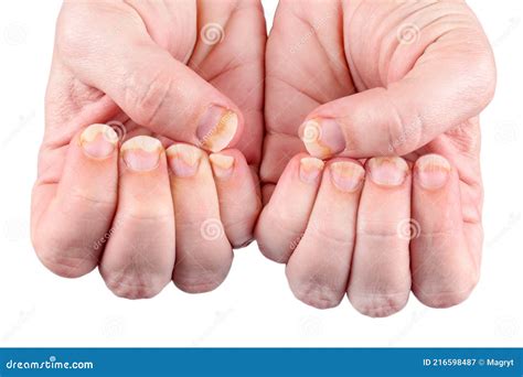 Onychomycosis Or Fungal Nail Infection On Damaged Nails After Gel