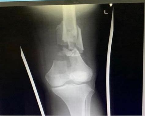 X Ray Showing Comminuted Fracture Of Distal Femur Left Download