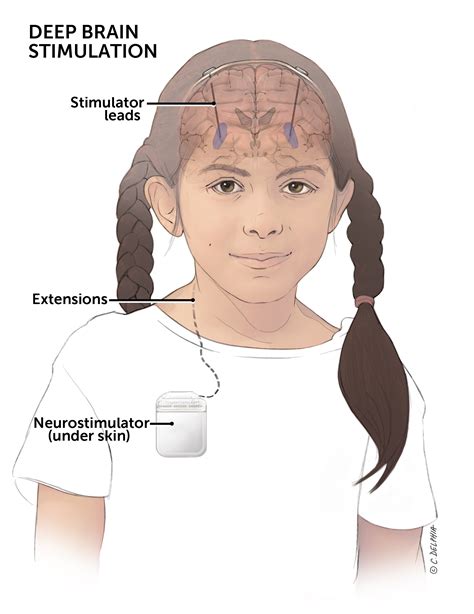 Deep Brain Stimulation Boston Childrens Hospital