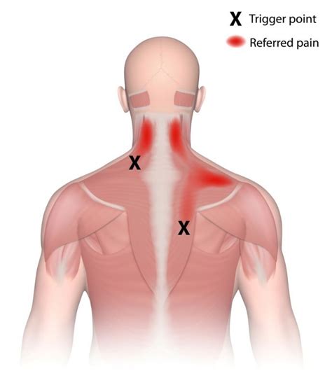 Neck And Shoulder Stress How To Relieve Trapezius Pain