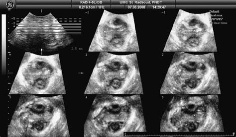 16 Tomographic Ultrasound Imaging In Oblique Axial Plane Right Sided