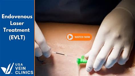 Endovenous Laser Treatment Evlt Youtube