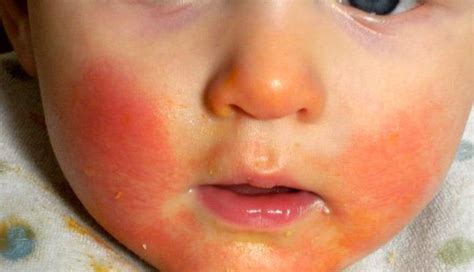 While you may have heard a lot about milk allergies and milk intolerance in babies, they're actually not that common. Milk Allergy Skin Rash | Foto Bugil Bokep 2017