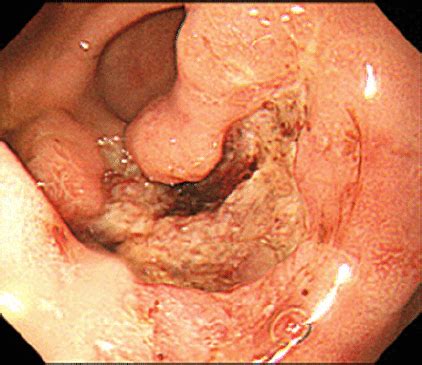 Because stomach cancer often causes no symptoms in its early stages, some people find out that their cancer is advanced when it is first diagnosed. Gastric endoscopy presents a large protruding mass with an ...