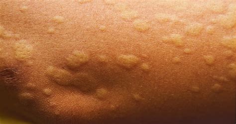 What Is Chronic Idiopathic Urticaria Hives Heathtips And Tricks